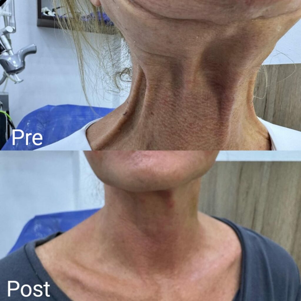 تقنية رقبة نفرتيتي في الغردقة